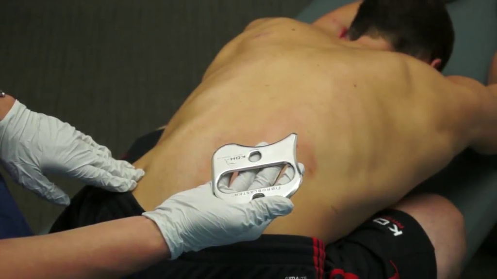 Instrument-Assisted Soft Tissue Mobilization (IASTM)